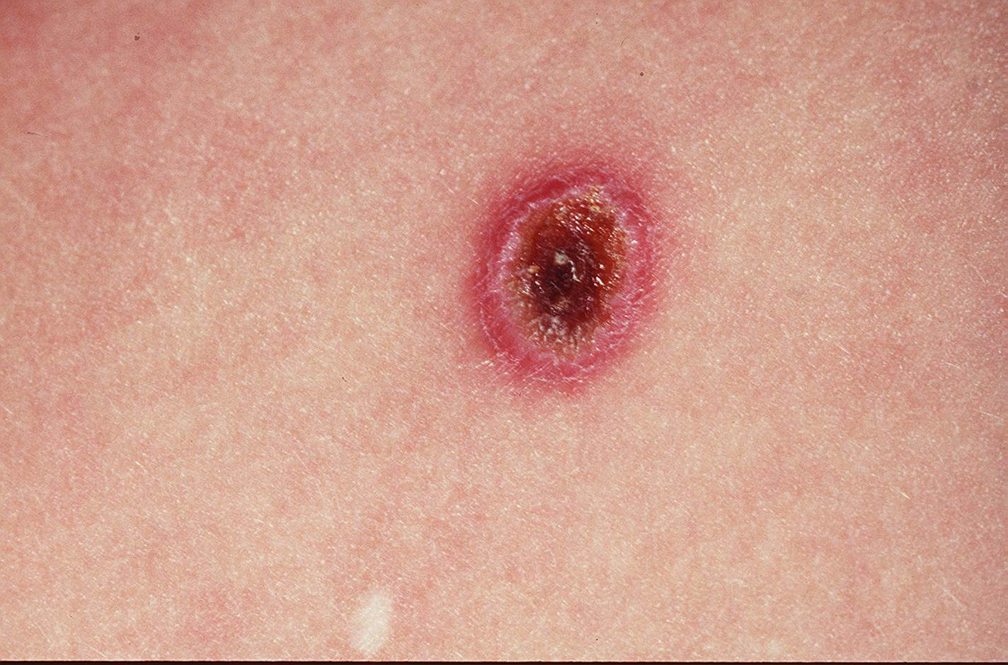 Scrub Typhus Eschar | right